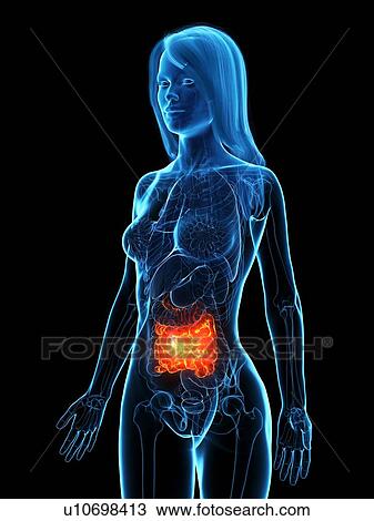 Stock Image - Diseased small intestine, illustration. Fotosearch