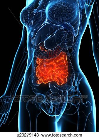 Stock Image - Diseased small intestine, illustration. Fotosearch