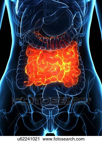 Stock Image - Diseased small intestine, illustration. Fotosearch