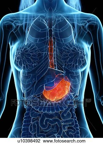 Stock Image - Diseased stomach, illustration. Fotosearch