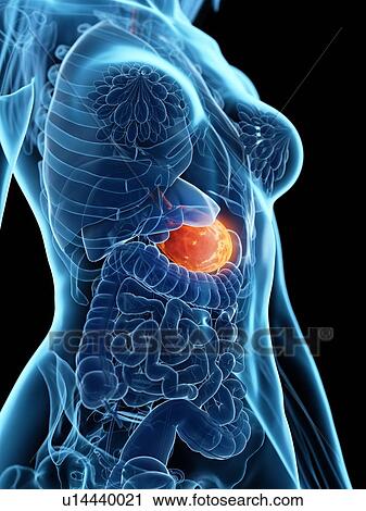 Diseased stomach, illustration View Large Photo Image Stock Image - Diseased stomach, illustration. Fotosearch