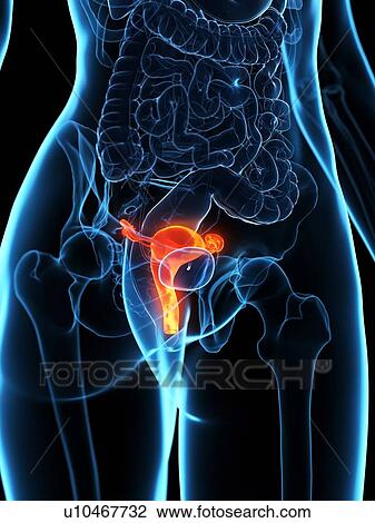 Stock Image - Diseased uterus, illustration. Fotosearch