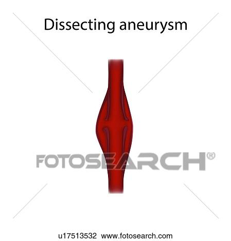 Stock Image - Dissecting aneurysm, illustration. Fotosearch