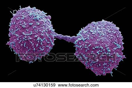 Dividing prostate cancer cells, SEM View Large Photo Image Stock Photo - Dividing prostate cancer cells, SEM. Fotosearch