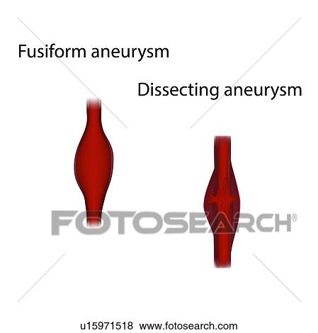 Stock Photo - Fusiform and dissecting aneurysms, illustration. Fotosearch