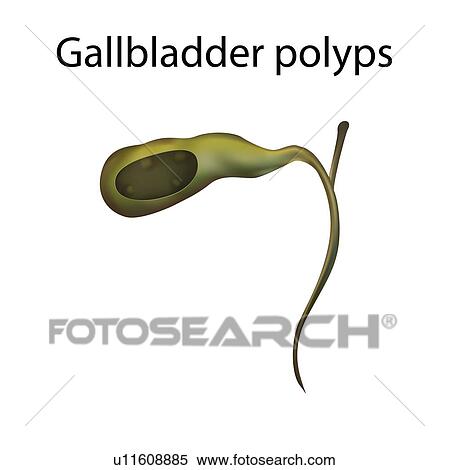 Stock Photography - Gallbladder polyps, illustration. Fotosearch