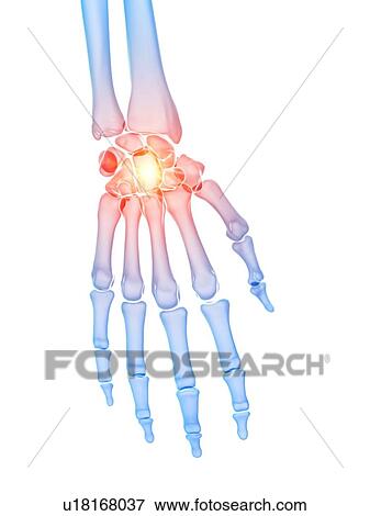 Stock Photo - Hand pain, conceptual illustration. Fotosearch