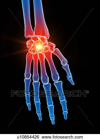 Stock Photograph - Hand pain, conceptual illustration. Fotosearch