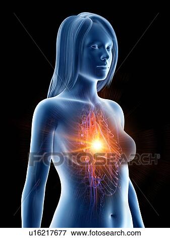 Stock Photo - Heart attack, conceptual illustration. Fotosearch