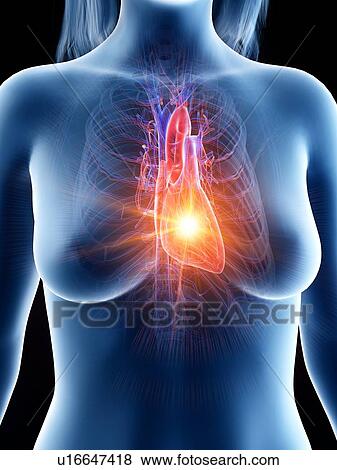 Stock Photo - Heart attack, conceptual illustration. Fotosearch