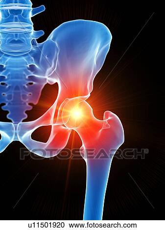 Hip pain, conceptual illustration View Large Photo Image Stock Image - Hip pain, conceptual illustration. Fotosearch