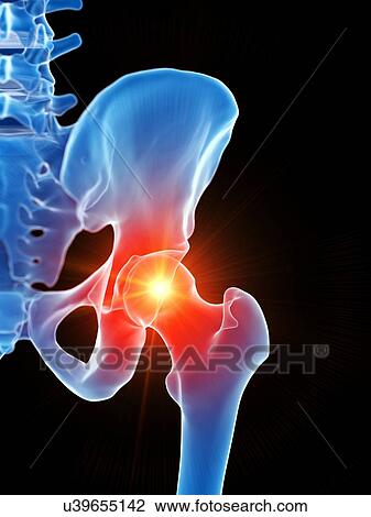 Stock Image - Hip pain, conceptual illustration. Fotosearch