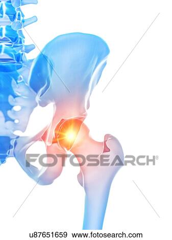 Hip pain, conceptual illustration View Large Photo Image Stock Photo - Hip pain, conceptual illustration. Fotosearch