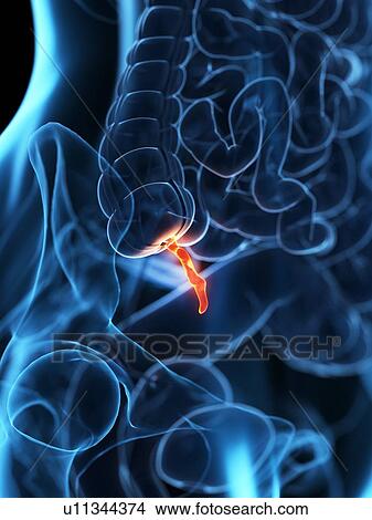 Picture - Inflamed appendix, conceptual illustration. Fotosearch