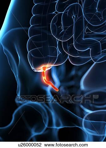 Stock Image - Inflamed appendix, conceptual illustration. Fotosearch