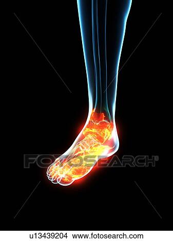 Picture - Inflamed ligaments, conceptual illustration. Fotosearch