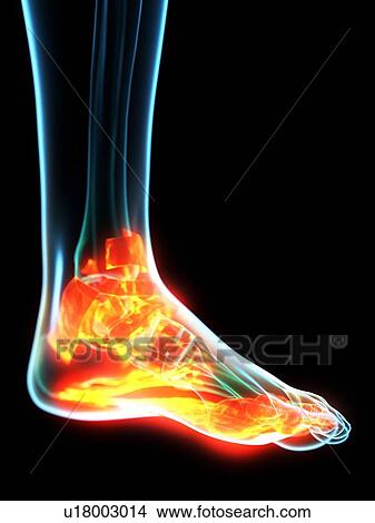 Picture - Inflamed ligaments, conceptual illustration. Fotosearch