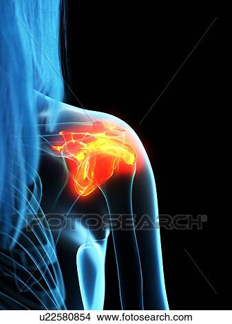 Picture - Inflamed ligaments, conceptual illustration. Fotosearch