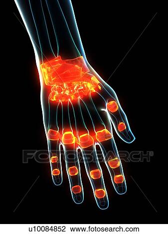 Inflamed ligaments, conceptual illustration View Large Photo Image Stock Image - Inflamed ligaments, conceptual illustration. Fotosearch