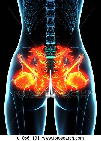 Stock Image - Inflamed ligaments, conceptual illustration. Fotosearch