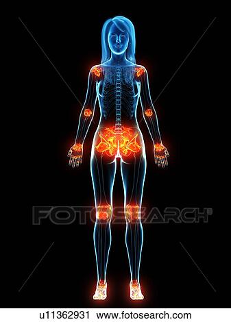 Inflamed ligaments, conceptual illustration View Large Photo Image Stock Image - Inflamed ligaments, conceptual illustration. Fotosearch