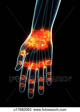 Stock Image - Inflamed ligaments, conceptual illustration. Fotosearch
