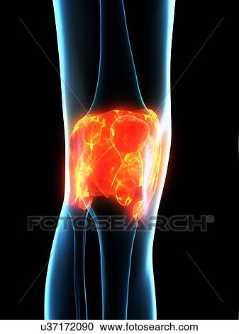Stock Image - Inflamed ligaments, conceptual illustration. Fotosearch