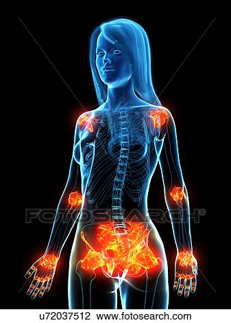 Stock Image - Inflamed ligaments, conceptual illustration. Fotosearch