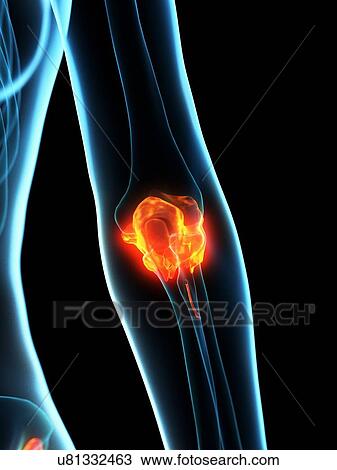 Inflamed ligaments, conceptual illustration View Large Photo Image Stock Image - Inflamed ligaments, conceptual illustration. Fotosearch