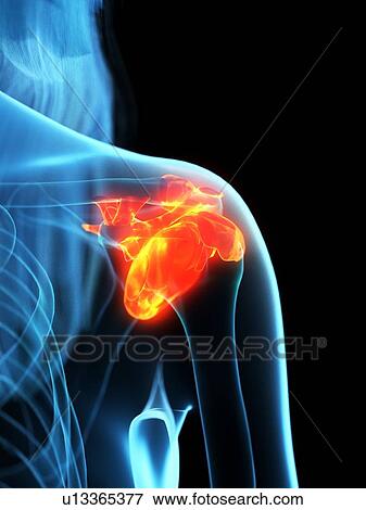 Inflamed ligaments, conceptual illustration View Large Photo Image Stock Photo - Inflamed ligaments, conceptual illustration. Fotosearch