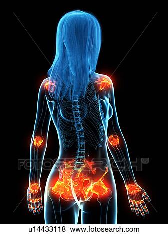 Stock Photo - Inflamed ligaments, conceptual illustration. Fotosearch
