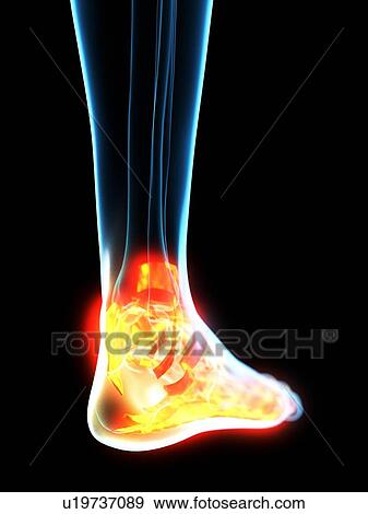 Stock Photo - Inflamed ligaments, conceptual illustration. Fotosearch