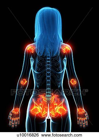 Stock Photograph - Inflamed ligaments, conceptual illustration. Fotosearch