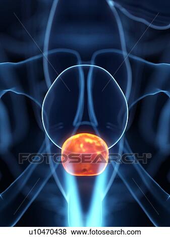 Stock Photo - Inflamed prostate, illustration. Fotosearch