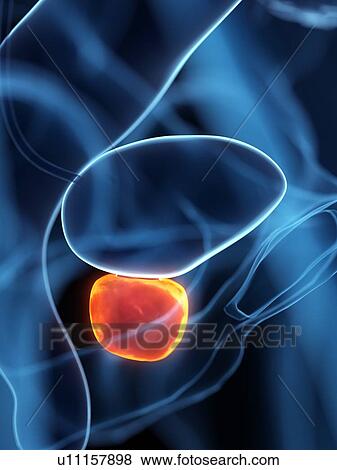 Stock Photo - Inflamed prostate, illustration. Fotosearch