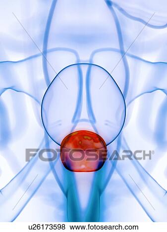 Stock Photo - Inflamed prostate, illustration. Fotosearch