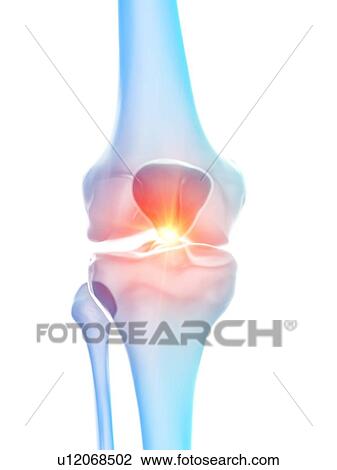 Stock Image - Knee pain, conceptual illustration. Fotosearch