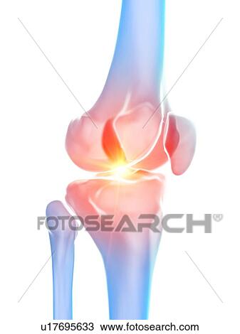 Stock Image - Knee pain, conceptual illustration. Fotosearch
