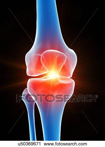 Stock Image - Knee pain, conceptual illustration. Fotosearch