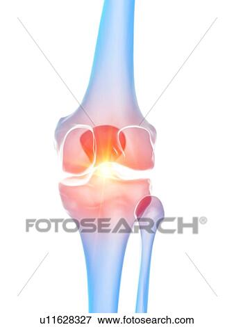 Stock Photo - Knee pain, conceptual illustration. Fotosearch