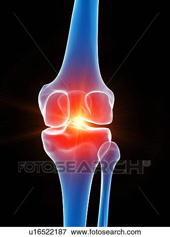 Stock Photo - Knee pain, conceptual illustration. Fotosearch