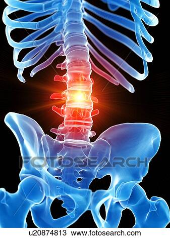 Lumbar pain, conceptual illustration View Large Photo Image Stock Image - Lumbar pain, conceptual illustration. Fotosearch