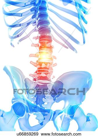 Stock Photo - Lumbar pain, conceptual illustration. Fotosearch