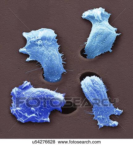 Stock Photo - Migrating sarcoma cancer cells, SEM. Fotosearch