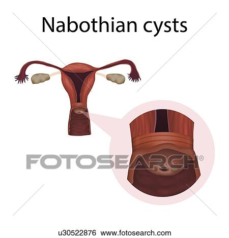 Stock Photograph - Nabothian cysts, illustration. Fotosearch