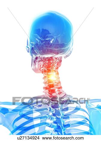 Neck pain, conceptual illustration View Large Photo Image Picture - Neck pain, conceptual illustration. Fotosearch