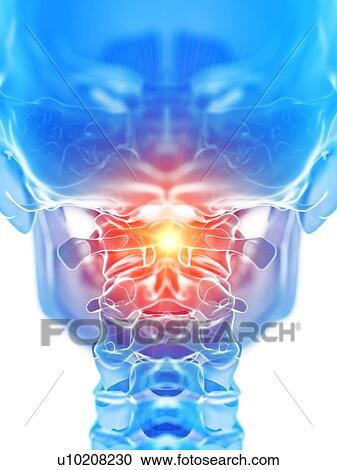 Stock Image - Neck pain, conceptual illustration. Fotosearch