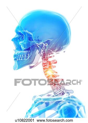 Stock Image - Neck pain, conceptual illustration. Fotosearch