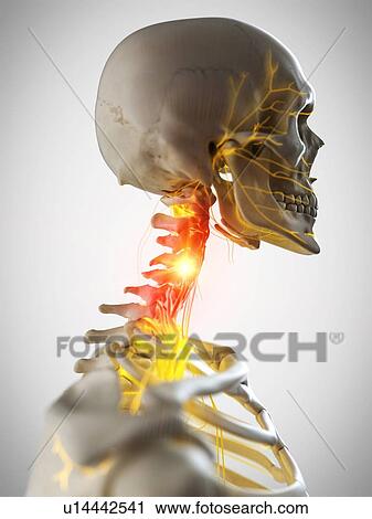 Neck pain, conceptual illustration View Large Photo Image Stock Image - Neck pain, conceptual illustration. Fotosearch