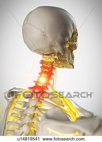 Stock Image - Neck pain, conceptual illustration. Fotosearch